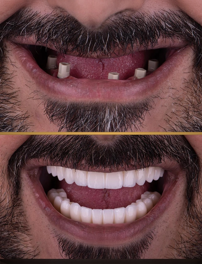 Dental Holiday in Antalya - Packages Deals, Cost & Price 2025