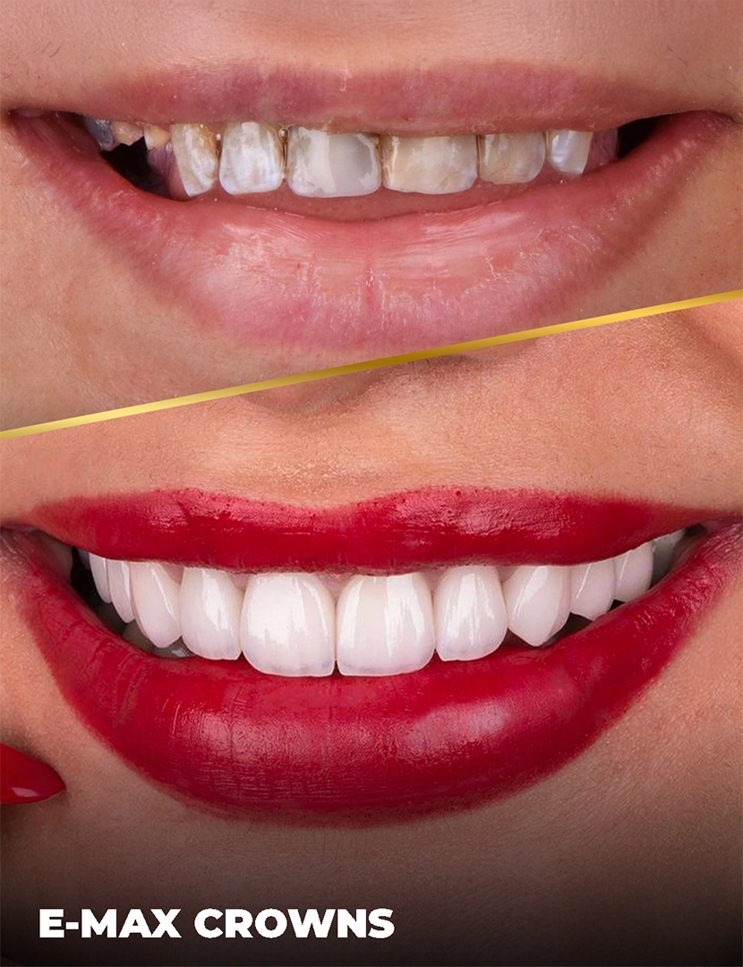 Dental Holiday in Antalya - Packages Deals, Cost & Price 2025