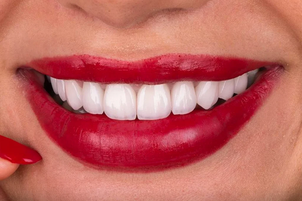 E Max Veneers