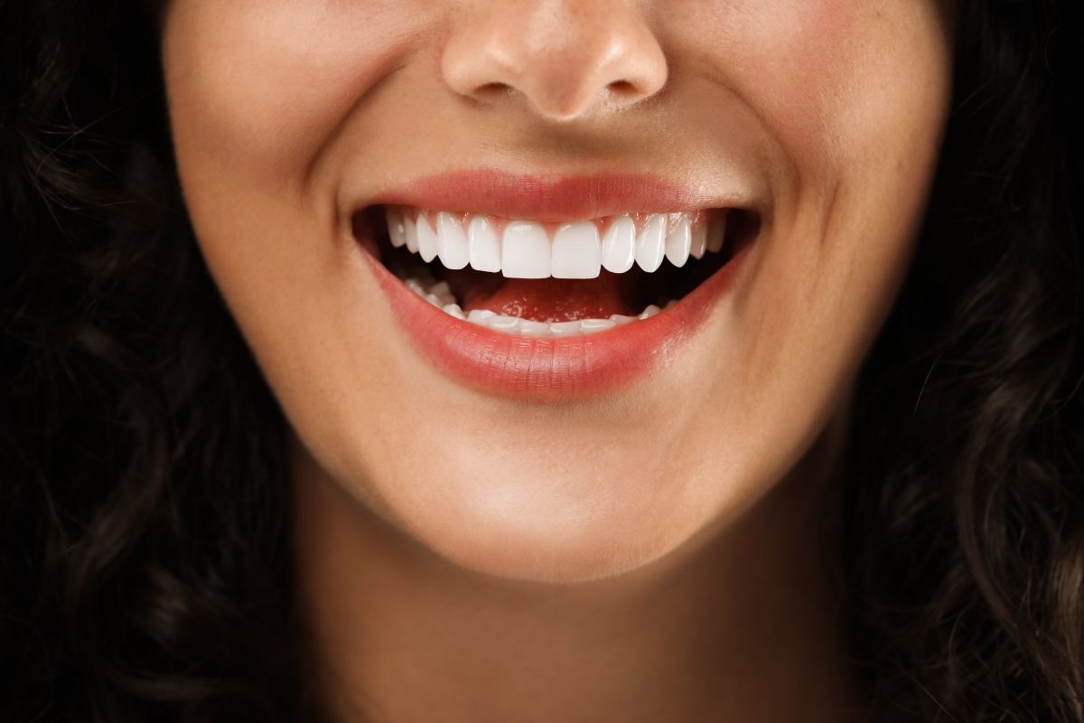 Laminate Veneers