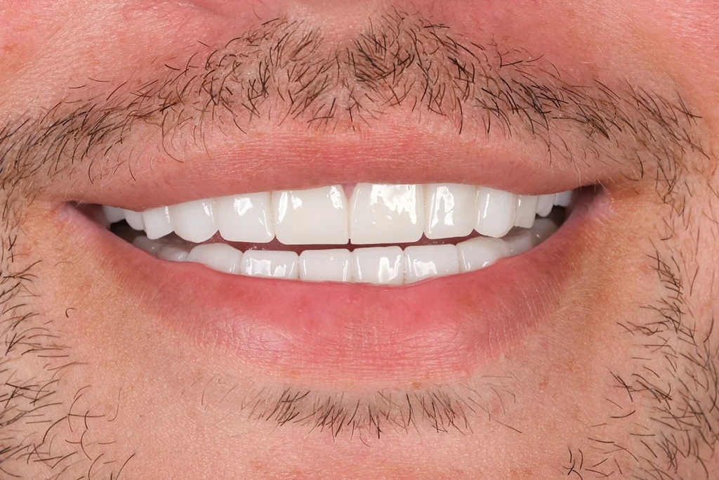 Zirconium Crowns