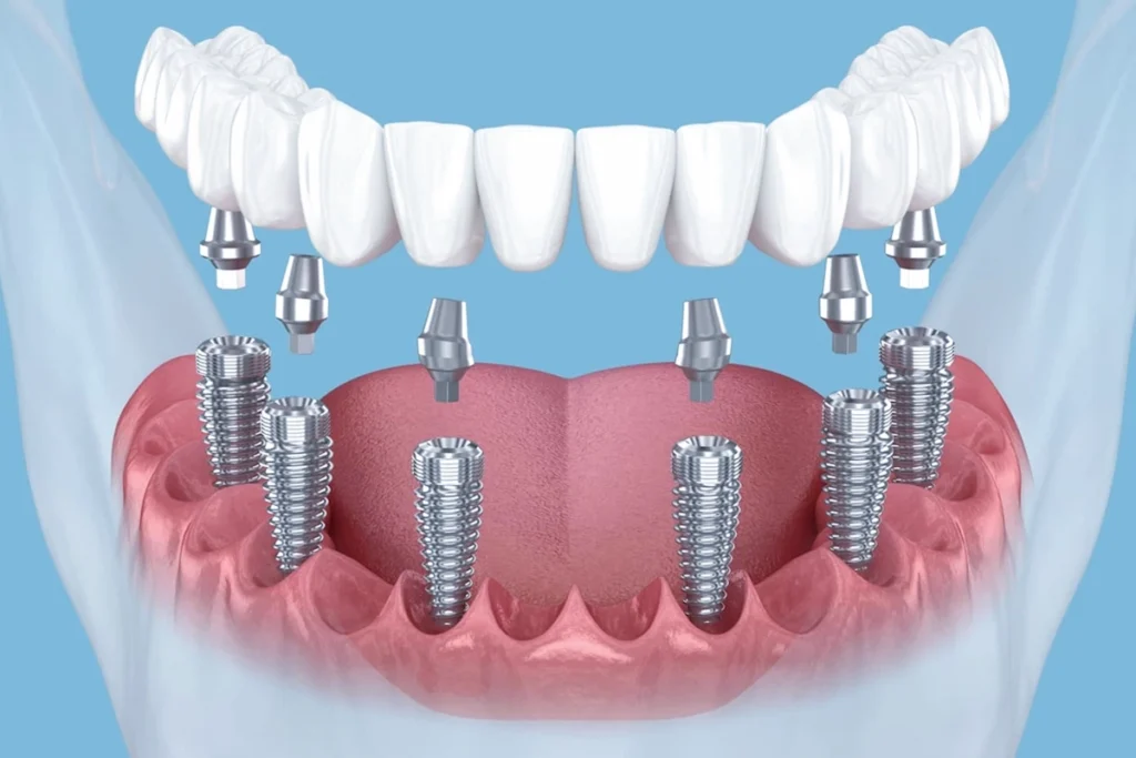 Full Mouth Dental Implants in Antalya: Restore Your Smile with Confidence