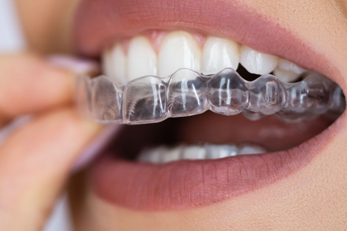Clear Aligner in Antalya 2025