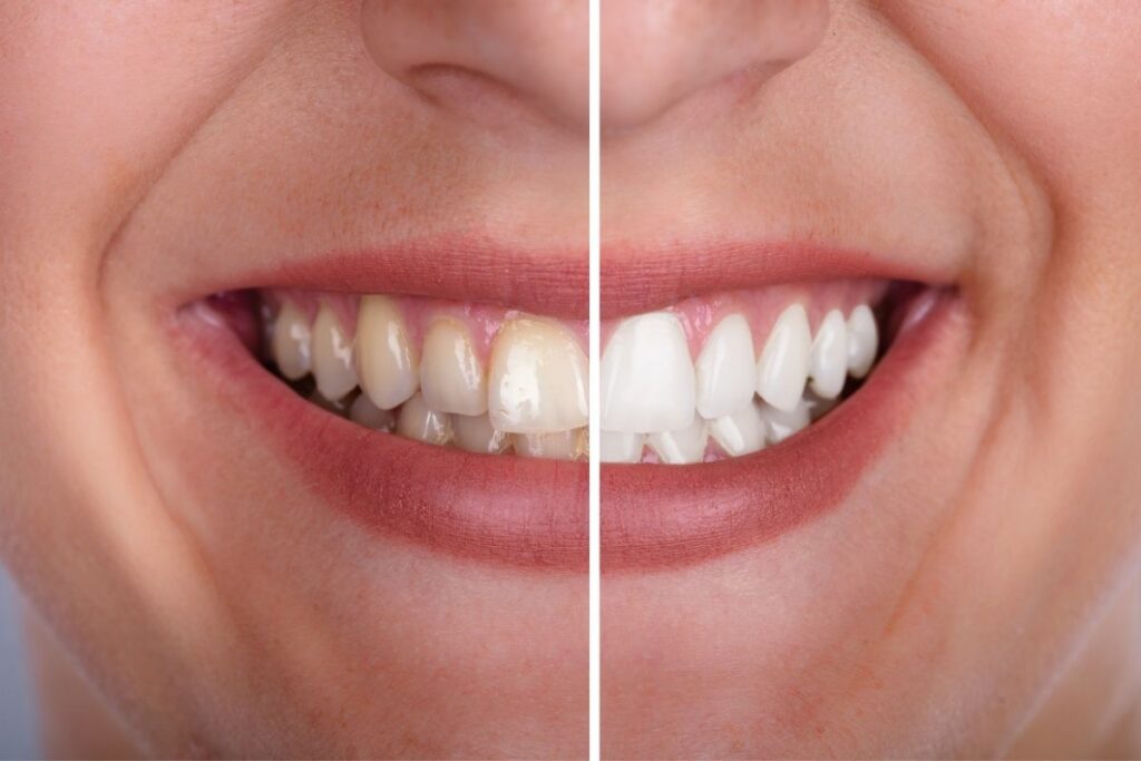 Composite Bonding in Antalya 2025