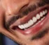 Composite Bonding in Antalya Turkey Teeth