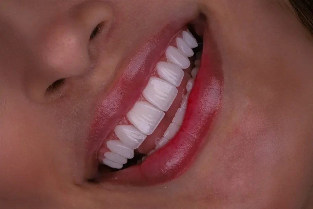 E Max Veneers in Antalya 2025