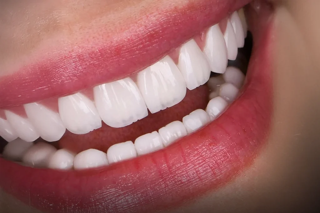 Hollywood Smile in Antalya Best Price