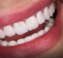 Hollywood Smile in Antalya Best Price