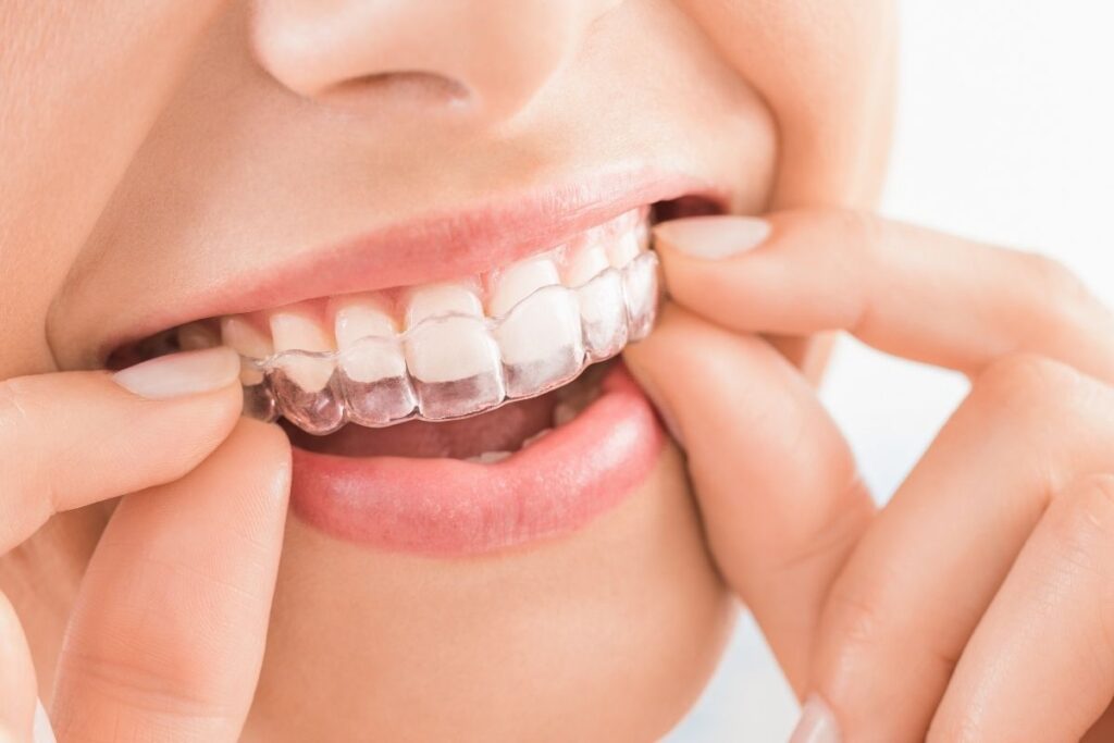 What is clear aligner 2025