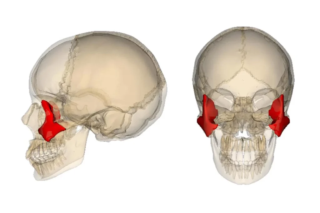 Zygomatic Implant in Antalya Cost