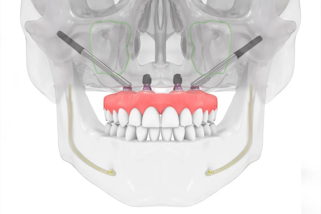 Zygomatic Implant in Antalya 2025