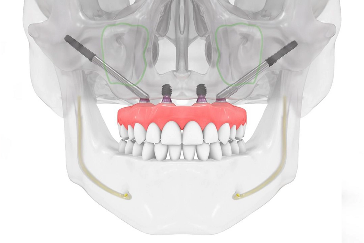 Zygomatic Implant in Antalya 2025